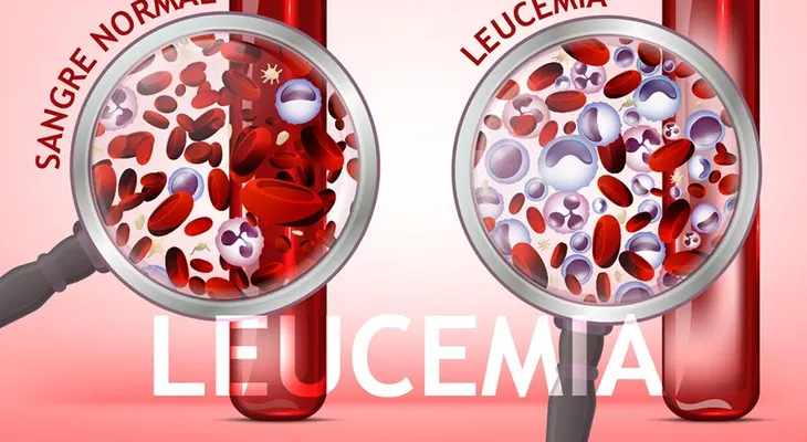 La leucemia tiene cura; 10 mitos y verdades para tratar esta enfermedad 