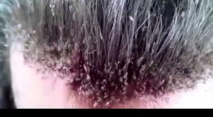 ¡Insólito! Este podría ser el peor caso de un hombre con piojos (VIDEO)