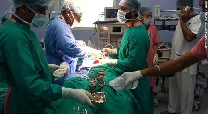 Retiran 40 cuchillos del estómago de un hombre en la India