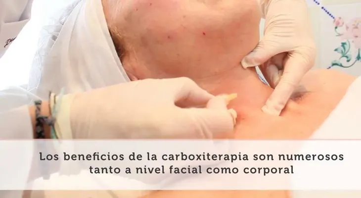 Los beneficios de la carboxiterapia