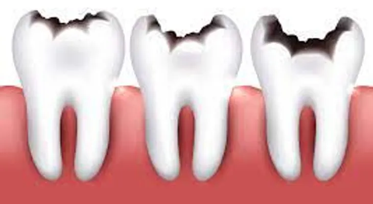 Cómo revertir el proceso de deterioro de los dientes y evitar que se forme una caries dental
