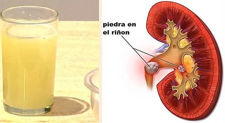 Así es como sale expulsada hasta la ultima piedra del Riñón con beber media taza de esta bebida