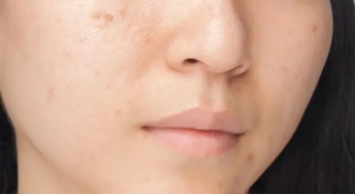 Estos 7 hábitos alimenticios están dañando tu rostro