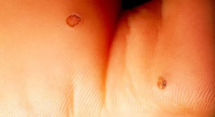 ¿Se puede contagiar el Vírus del Papiloma Humano con el sexo oral?