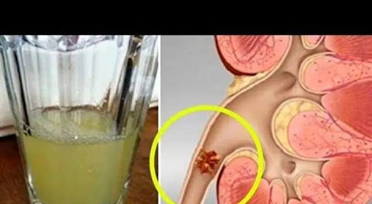 Este remedio expulsa todas las piedras que tenga en los riñones