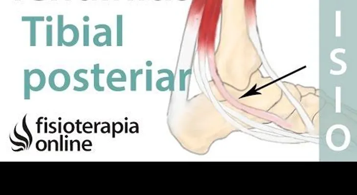 Ejercicios para la tendinitis tibial Posterial (VIDEO)