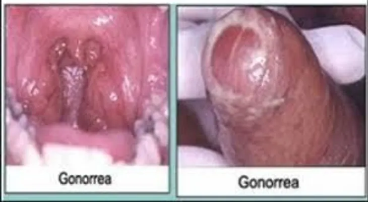 Consecuencias de una gonorrea, explicada por un experto
