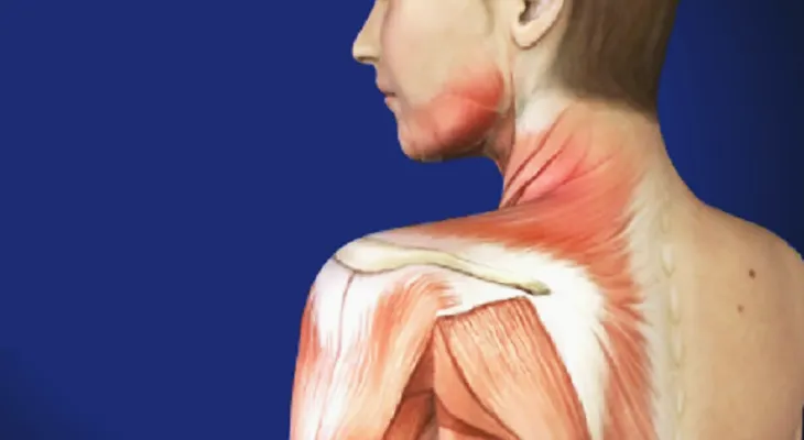 Síndrome del Dolor Miofascial y la fibromialgia
