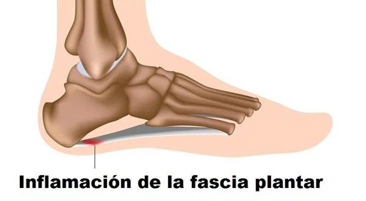 Fascitis plantar prevención y tratamientos en casa