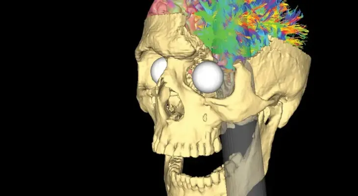 Tres lesiones cerebrales que cambiaron la ciencia de la mente