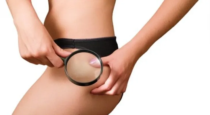 Cellfina, nuevo tratamiento contra la celulitis