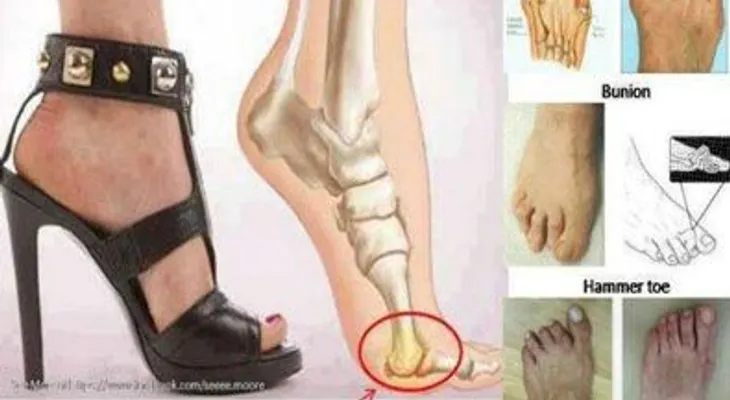 Zapatos de tacón alto causan deformaciones en pies