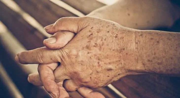 Manchas de la edad y cómo prevenirlas