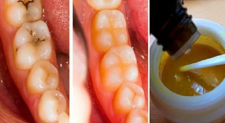 Revierte las caries con estas potentes mascaras para tus dientes