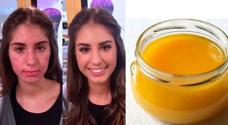 Esta fruta elimina de por vida el acné y espinillas. INCREIBLE!