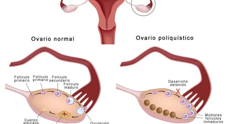 Curar el síndrome de ovario poliquístico