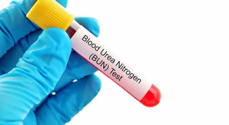 Los niveles de urea elevados en la sangre aumentan el riesgo de diabetes tipo 2