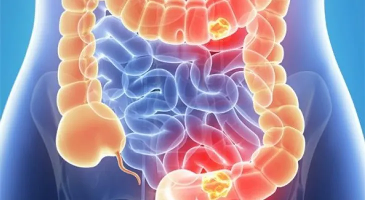 Las ventajas de detectar el cáncer de colon a los 50 años
