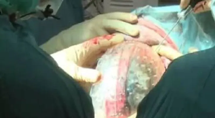 Médicos holandeses implantan por primera vez un cráneo de plástico impreso en 3D