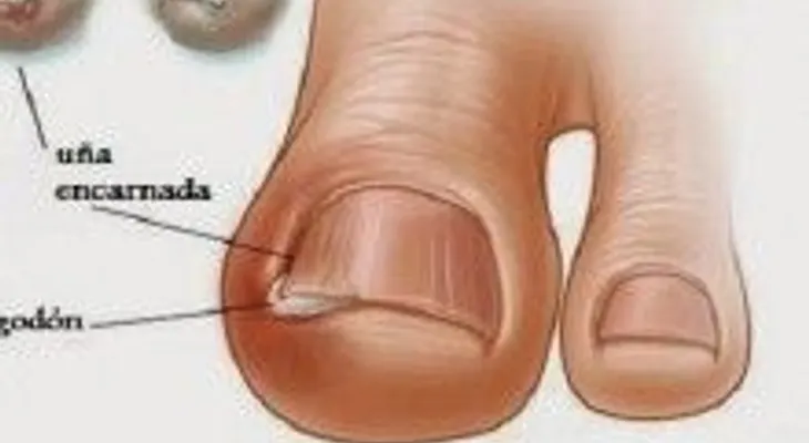 Estos trucos sencillos te salvarán para simpre de las dolorosas uñas encarnadas 