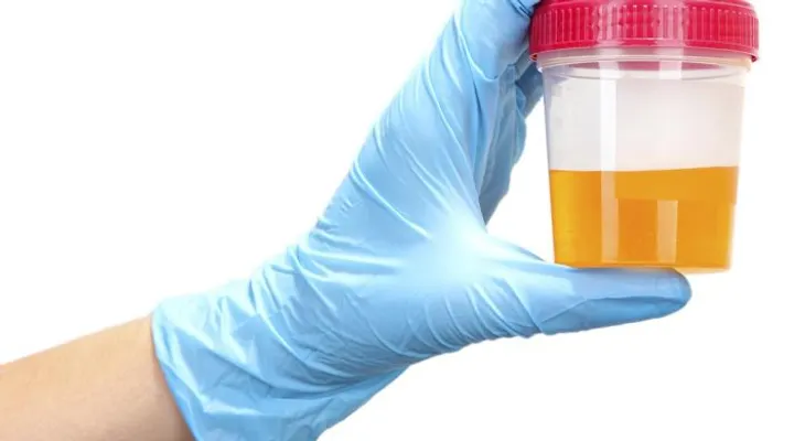 ¿Cómo se detecta la sangre en la orina?