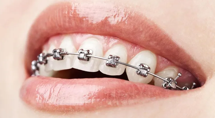 En realidad los aparatos son malos para los dientes y tu salud bucal