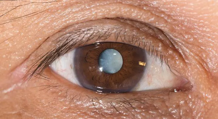 Gotas en los ojos podrían ser la solución para curar las cataratas