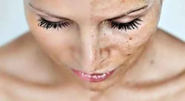 El descuido prematuro de la piel puede ocasionar el padecimiento del Melasma