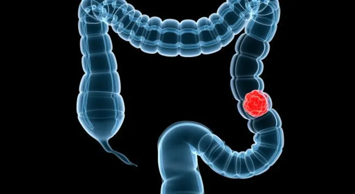 Aprueban examen contra cáncer de colon en EEUU 