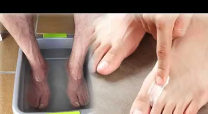 Conoce estos remedios caseros para curar hongos uñas de los pies (VIDEO)