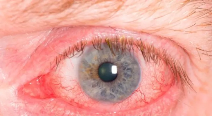  Cómo eliminar naturalmente el enrojecimiento de los ojos. 