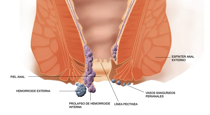 Cómo curar las hemorroides con remedios caseros
