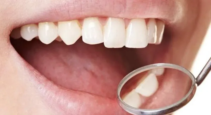 Las infecciones en boca pueden causar desde amigdalitis a cardiopatías