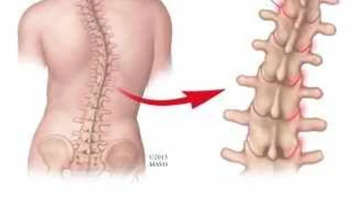 Cambios degenerativos en la columna vertebral: ¿Artritis?