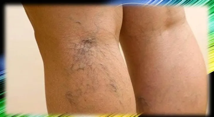 Remedio para quitar las varices en las piernas 