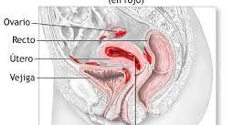 Analgésicos para la endometriosis: ibuprofeno (Advil, Motrin IB, otros) o naproxeno sódico (Aleve)
