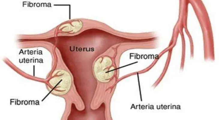 7 señales de advertencia de miomas uterinos
