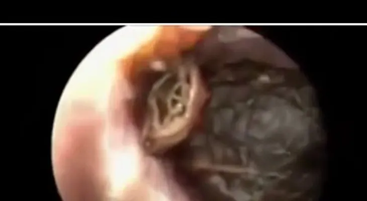 Sacan 26 cucarachas del oído de un joven (Vídeo)