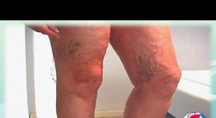 Remedios naturales para las varices y arañitas en las piernas (venas varicosas)