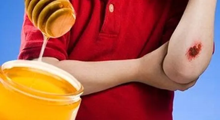 Poner miel a las heridas ayuda a curarlas más rápido y detiene el crecimiento de bacterias  