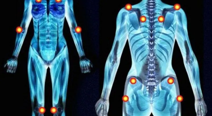 5 síntomas tempranos de la fibromialgia