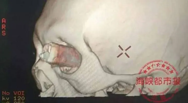 IMAGENES FUERTES: Un hombre llegó a un hospital de China con un cuchillo clavado en un ojo