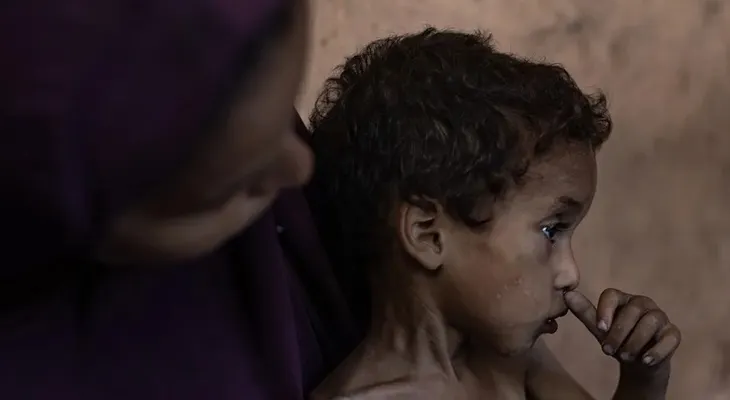 Desnutrición acaba con la vida de cinco gazatíes, entre ellos un bebé y dos niños, en 24 horas