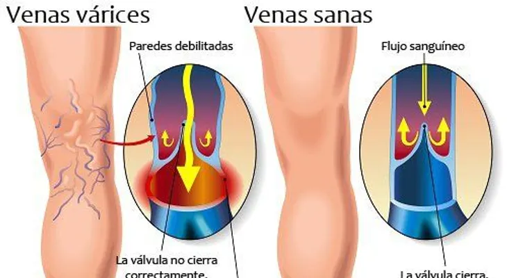  Los ejercicios también sirven para las varices; cuáles son recomendados 