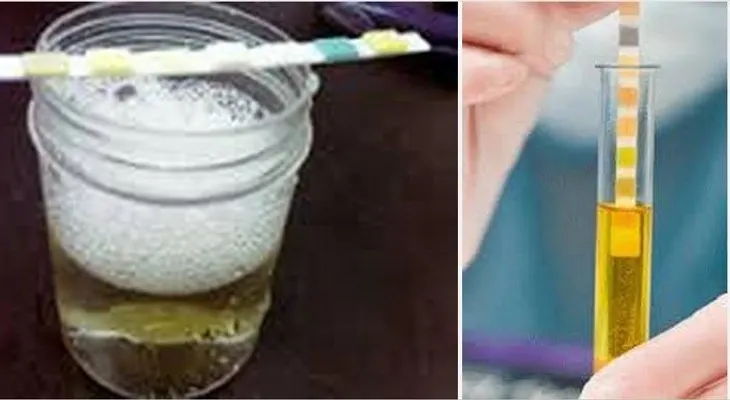 Los problemas de salud si la orina hace espuma!