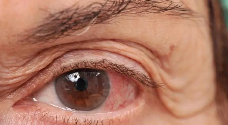 Ojo seco es un problema de salud que afecta a mujeres en la menopausia