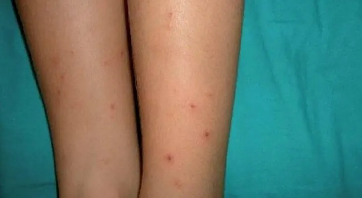 Nicaragua en alerta extrema sanitaria por chikungunya