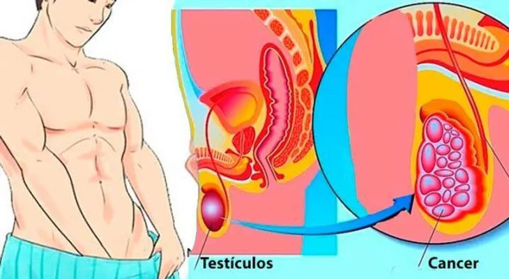 Los síntomas del cáncer testicular para acabar con él antes que se desarrolle 