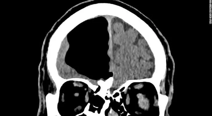 Médicos hallan una bolsa de aire en el cerebro de un hombre