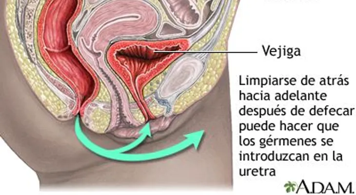 ¿Cuáles son las causas de la infección del tracto urinario?